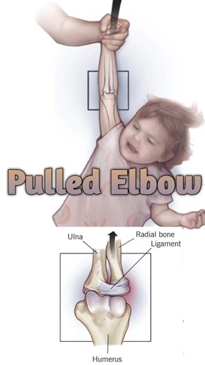 Pulled Elbow |हाथ का खिंचाव |#drkamleshpaliwal #healtheducation #doctor #facts #healthawareness