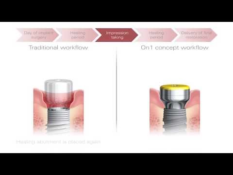 The On1 concept - the best of both worlds | Nobel Biocare