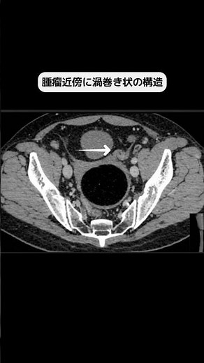 卵巣奇形腫の茎捻転#radiology #anatomy #CT #shorts#画像診断