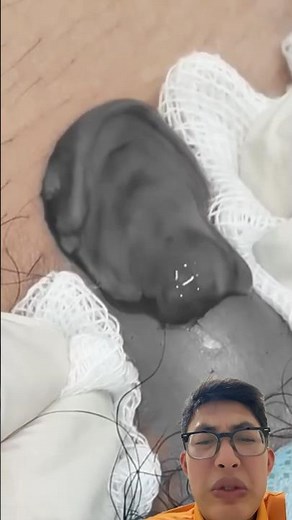 Popping Bikini Abscess Pimples: Watch the Results After Popping!
