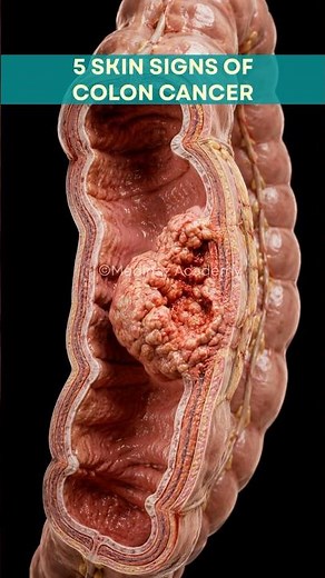 5 Skin Signs That May Be Linked to Colon Cancer 🚨