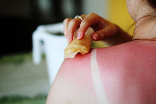 How to Tell if Your Nasty Sunburn Has Turned Into Sun Poisoning, According to Doctors