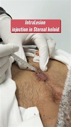 Intralesion injection in Sternal keloid.#IntralesionalInjection #SternalKeloid #KeloidTreatment