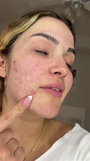 Effective Pimple Patch Treatment: A Quick Review