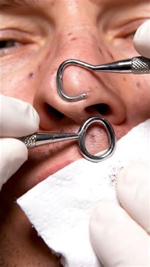 “Most Satisfying Small Blackhead Extraction – Full Face ASMR Loop | Extreme Hard Blackhead Removal”