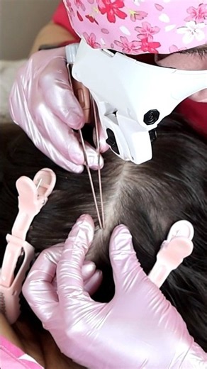 ASMR Doctor LICE Check on Scalp and Neck | Lice Removal with Tweezers #short #asmr #shorts