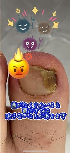 削って治そう！爪水虫！#爪水虫 #爪水虫の治し方 #爪削り #グラインダー #爪白癬 #爪白癬ケア #白癬 #水虫 #皮膚科 #美容皮膚科 #こはく皮フ科クリニック #こはく皮膚科クリニック