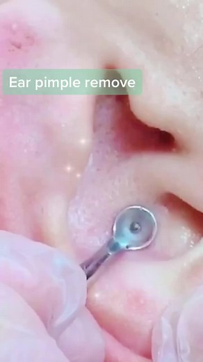 #greenscreenvideo #pimplepopping #pimpleremover #extractions #pimple #acne #zitpopper Oddly satisfying