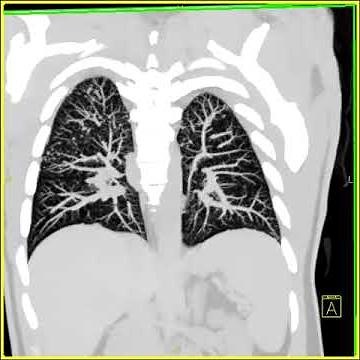 Lung Anatomy: Sarcoidosis