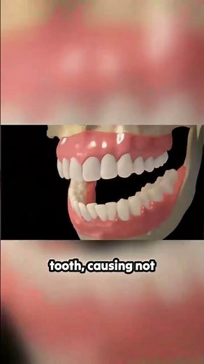 Complete Wisdom Tooth Extraction — Step by Step Guide