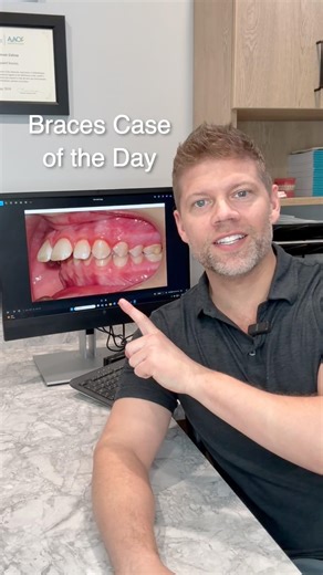 Braces Case Of The Day: Fixing Overjet And Overbite With A MARA