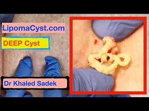 Dr Khaled Sadek. 3year Back Cyst. LipomaCyst.com