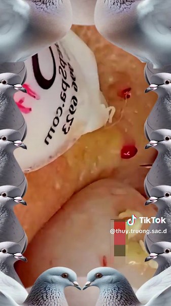 "So smooth and satisfying! 👏🔥😍"#fyp #viral_video #tik_tok #pimple #...