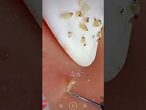 Skincare | Blackheads Removal #827 #tweezers skincare #blackheads blackheads