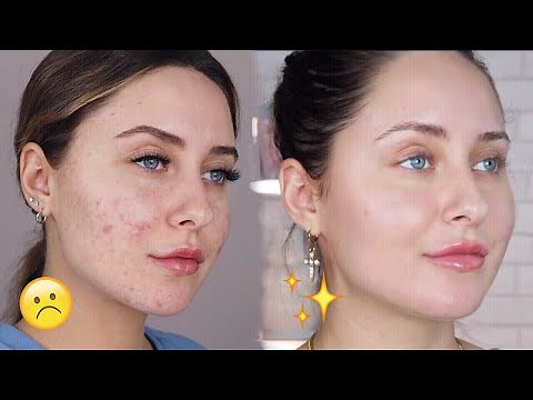 HOW TO GET RID OF ACNE SCARS + DARK SPOTS