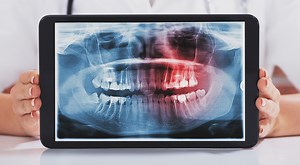 Wisdom Teeth: Pictures, Symptoms, Surgery, & Pain Relief