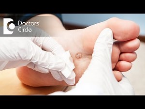 What is Dyshidrotic Eczema? - Dr. Sudheendra Udbalker