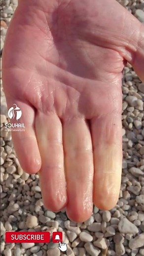 Raynaud's disease