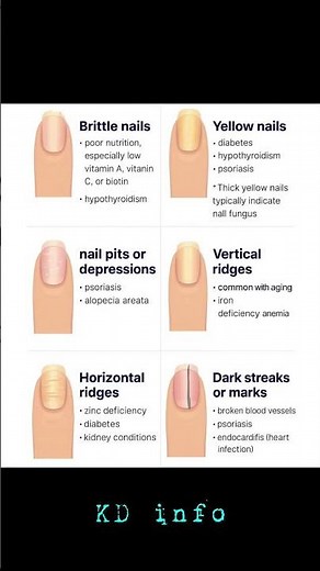 Types of nails