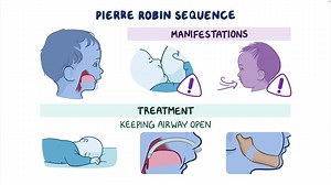 Video: Pierre Robin sequence: Year of the Zebra - Video Explanation! | Osmosis | Osmosis