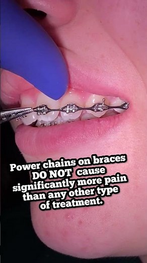 What to expect when you get POWER CHAINS Braces Checkups - Tooth Time New Braunfels Dentist