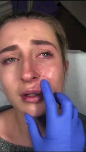 The Consultant Clinic on Instagram: "This was caused by an injector whom had no dissolving agent in her office because she didn't know how to use it 🙀. We often talk to you about the most dangerous aesthetics complication of all - an intravascular injection. Filler blocking an artery, and blood supply. This is exactly what that looks like ... a labial artery occlusion with prolonged capillary refill time. Capillary reflow is the time it takes for the blood flow to return to the lip after compre