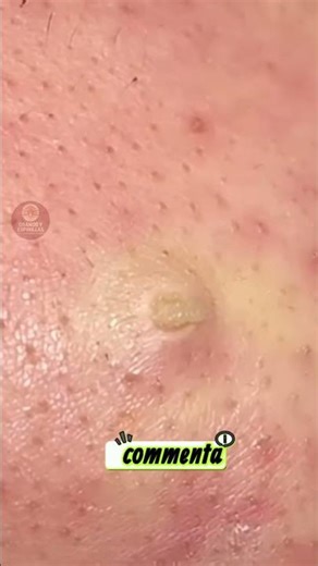 SHOCKING Circular Pimple Extraction 🔥💥 | Volcano-Like Yellow Pus Explosion!