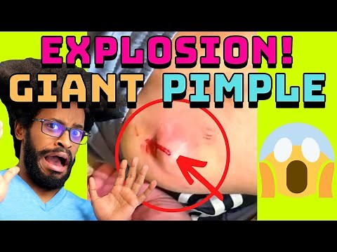 Giant Pimple Explosion Cyst Popping | Acne Pus Blackheads Bursting | ASMR Satisfying 37# 😱😱