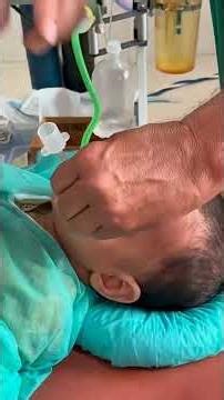 intubation of general anesthesia.