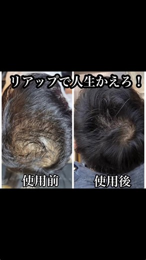 リアップによる増毛成功の秘訣