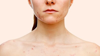 Troubled With Chest acne? Here Are Its Causes And Home Remedies To Get Rid Of It