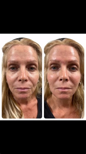 Gaby FNP~ Advanced Practice Aesthetic Injector💉 on Instagram: "🌟 Achieving the Radiant Glow with Radiesse for Lifted Cheeks and Jowls! 🌟 1/ 🧖‍♀️ What is Radiesse? Radiesse is a dermal filler known for adding volume and contour to various facial areas. It’s especially popular for lifting cheeks and jowls, giving a youthful, rejuvenated look. 2/ 💉 How Does Radiesse Work? Unlike other fillers, Radiesse stimulates your body’s own collagen production. The result? Not just immediate volume but al