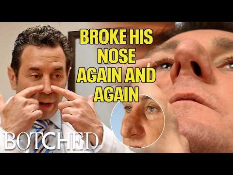 Disintegrating Septum?! Michael Broke His Nose One Too Many Times (Before & After) | Botched | E!