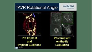 Cardiac CT Applications for Structural Heart Interventions