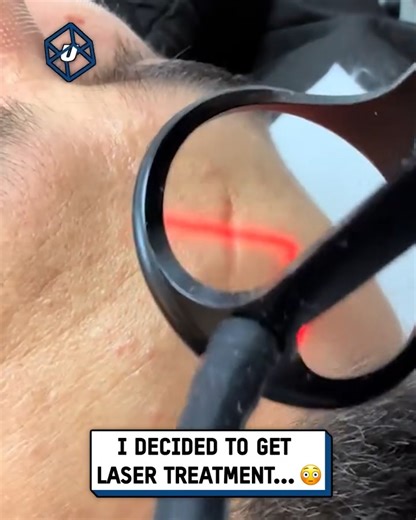 I used lasers to heal the scarring on my face 😮💥 #skincare #dermatology #laser | UNILAD Tech