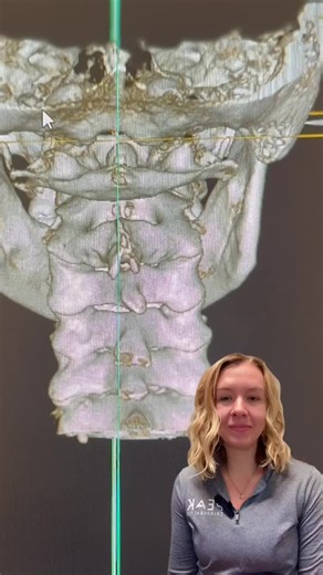 ⚡Seizures are a symptom of extreme dysfunction within the nervous system! ⚡ If you are someone who suffers from these, you have probably been everywhere and gone to almost every profession out there, but what these other professions don't look at is your spine and how the top two bones around your brainstem are aligned or lack-thereof. Meaning, yes the answer to your seizures literally could be solved from an Upper Cervical Chiropractic adjustment. 😮 When looking for an Upper Cervical Chiroprac