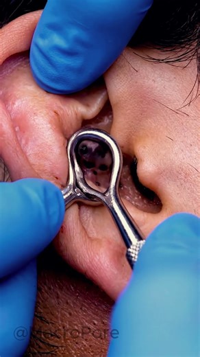 Ear Comedone Cluster Extraction | 4K Macro ASMR