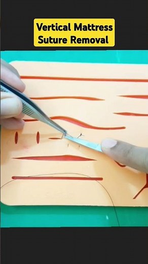 Vertical Mattress Suture Removal