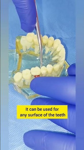 Mastering art of luxating tooth. #oralsurgery #luxators #dentaltips #extraction