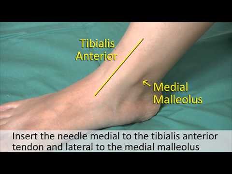 Musculoskeletal Examination and Joint Injection Series_ Ankle Joint Aspiration