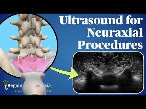 Ultrasound for Neuraxial Procedures