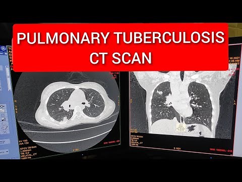 Pulmonary Tuberculosis CT scan Findings.