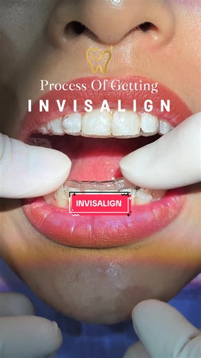 Invisalign Process at Dream Smile Dental Clinic, Sunway Geo