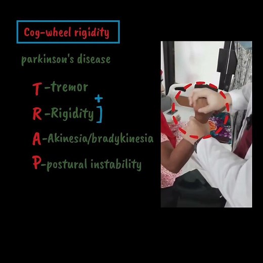 Cog-wheel Rigidity | Parkinson's disease