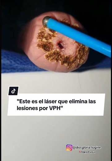 Esferorolisis: Tratamiento eficaz para el VPH