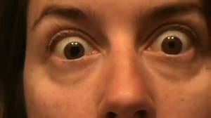 ANISOCORIA La diferencia en el diámetro entre una pupila y la contralateral se denomina Anisocoria (Pupilas de diferentes tamaños). La anisocoria es generalmente una condición que no tiene ningún efecto sobre la salud general de los ojos. A esta condición, la cuál es relativamente común, se le llama anisocoria fisiológica, y se presenta en una de cinco personas con algún grado de diferencia en el tamaño de sus pupilas. Sin embargo, la anisocoria puede ser también un síntoma de un trastorno ocul