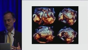 ASD Closure Devices in Adults. Value of Different Imaging Modalities