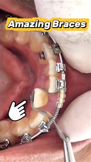 Orthodontist Secret: The best braces hack! 🤫✨ #braces #orthodontist #dentistry