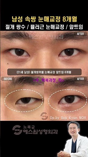 남자눈수술,눈매교정술