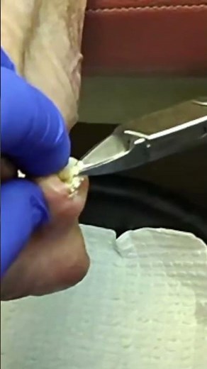 Why Your Toenails Keep Pinching Your Skin (Curved Nail Explained)